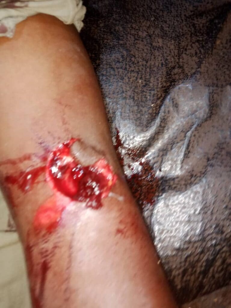 Wounded leg of a young boy by the Military. Credit: Ekani Olikita.