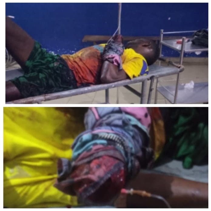 Jerry Saleh, one of the victims of Fulani Militia attack whose hand was amputated Credit: Ekani Olikita